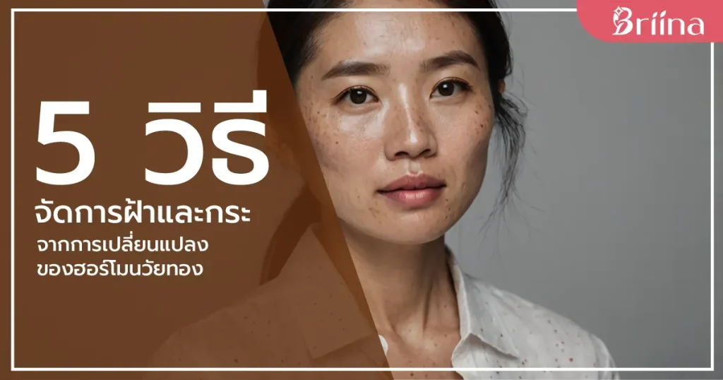 5-ways-freckles-and-melasma-from-hormonal