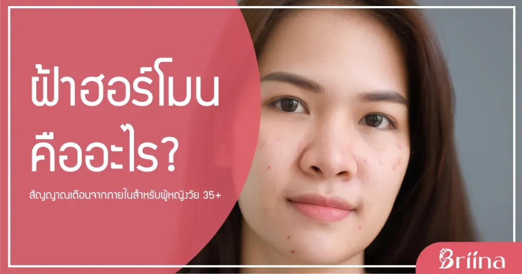 hormonal-melasma-sign-from-within